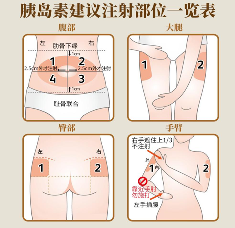 C:\Users\admin\Desktop\20230314胰岛素注射\微信图片_20230316134812.png
